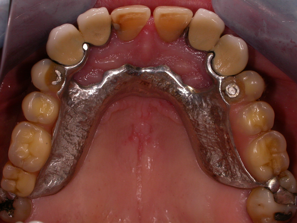 Herausnehmbare Modellguß-Prothese